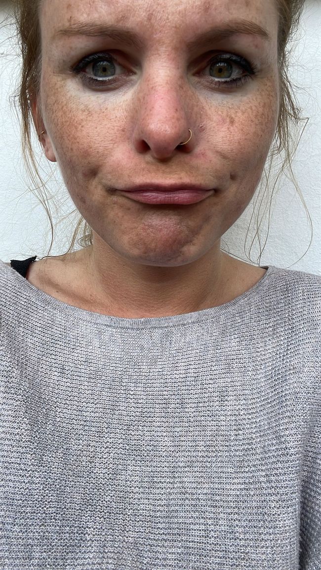 Morphea